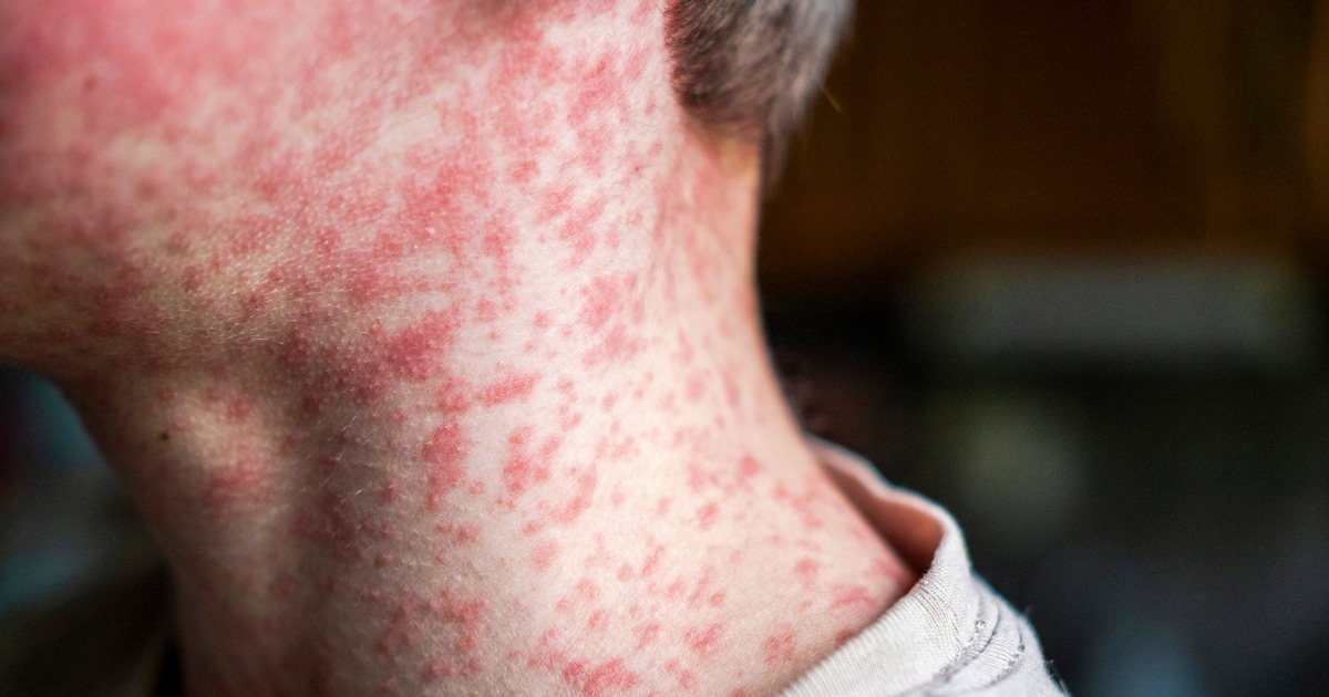 More measles in South Carolina imperils U.S. elimination status